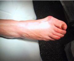 Ефективні вправи від кісточок на ногах Упр для пальців стопи ніг
