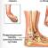 Cum să înveți să calci corect pe picior după o fractură de gleznă Diferența dintre osteopenie și osteoporoză